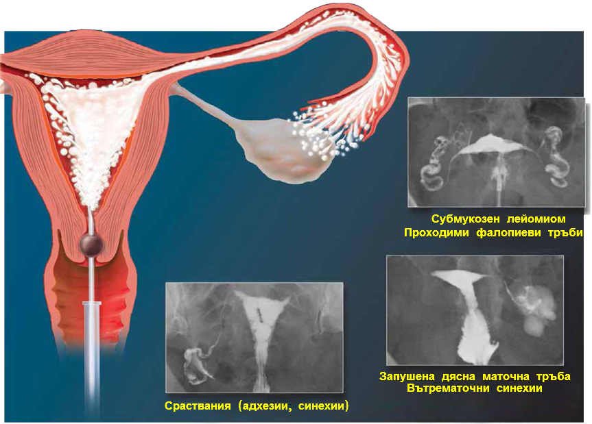 Хистеросалпингография (цветна снимка на матката и фалопиевите тръби)