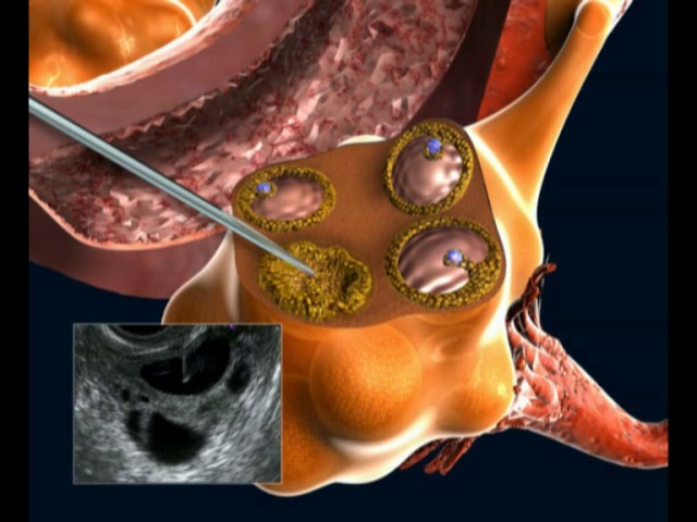 Ин Витро (IVF): пункция на фоликули, събиране на яйцеклетки