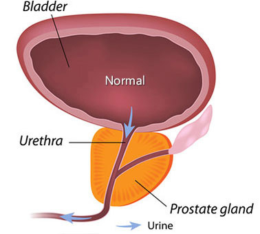 A prosztatitis megjelenésének oka, Prostatitis - Savia Health
